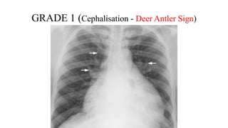 GRADE 1 (Cephalisation - Deer Antler Sign)
 