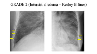 GRADE 2 (Interstitial edema – Kerley B lines)
 