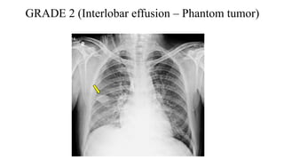 GRADE 2 (Interlobar effusion – Phantom tumor)
 