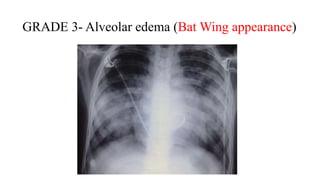 GRADE 3- Alveolar edema (Bat Wing appearance)
 
