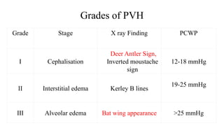 Grades of PVH
Grade Stage X ray Finding PCWP
I Cephalisation
Deer Antler Sign,
Inverted moustache
sign
12-18 mmHg
II Interstitial edema Kerley B lines
19-25 mmHg
III Alveolar edema Bat wing appearance >25 mmHg
 