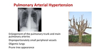 Pulmonary Arterial Hypertension
Enlargement of the pulmonary trunk and main
pulmonary arteries
Disproportionately small peripheral vessels
Oligemic lungs
Prune tree appearance
 