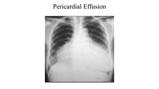 Pericardial Effusion
 