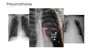 Pneumothorax
 