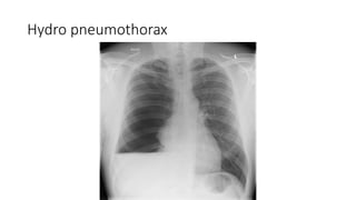 Hydro pneumothorax
 