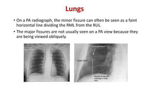 Lungs
• On a PA radiograph, the minor fissure can often be seen as a faint
horizontal line dividing the RML from the RUL.
• The major fissures are not usually seen on a PA view because they
are being viewed obliquely.
 