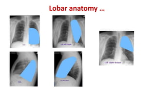 Lobar anatomy …
 