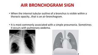 AIR BRONCHOGRAM SIGN
• When the internal tubular outline of a bronchus is visible within a
thoracic opacity...that is an air bronchogram.
• It is most commonly associated with a simple pneumonia. Sometimes
it occurs with pulmonary oedema.
 