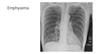Emphysema
 