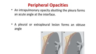 Peripheral Opacities
 