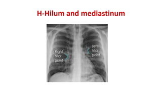 H-Hilum and mediastinum
 