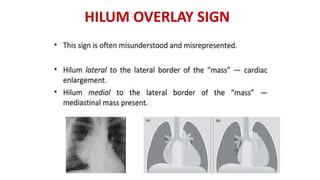 HILUM OVERLAY SIGN
 