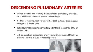 DESCENDING PULMONARY ARTERIES
 
