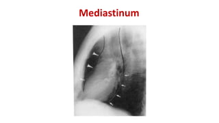 Mediastinum
 