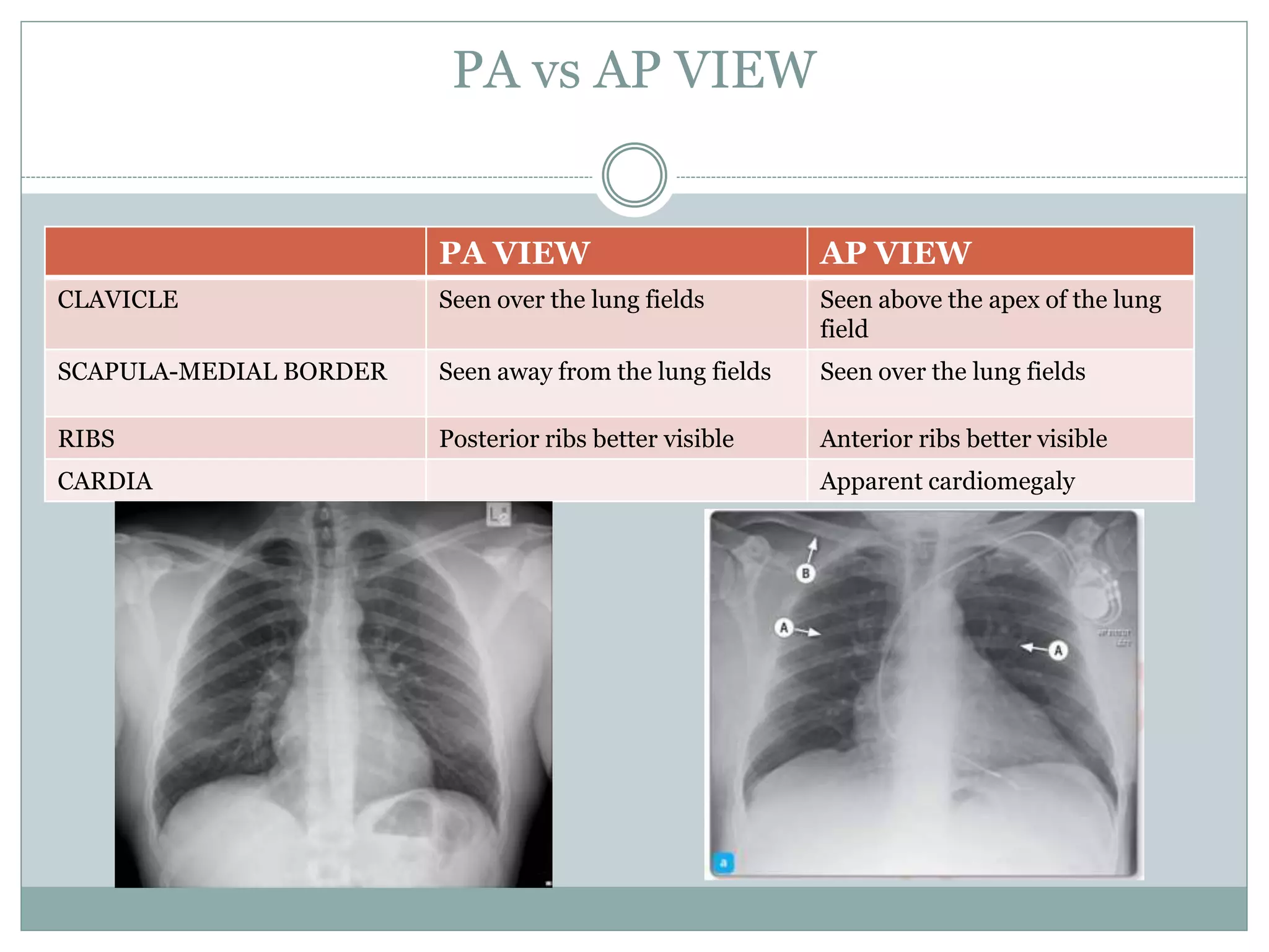 Chest X Rays | PPT