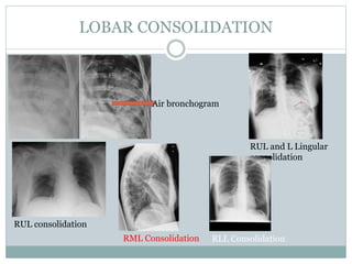 Chest X Rays | PPTX