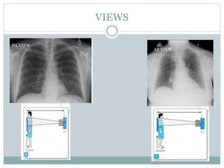 Chest X Rays | PPTX