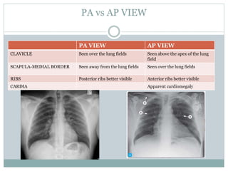 Chest X Rays | PPTX