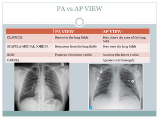 Chest X Rays | PPT