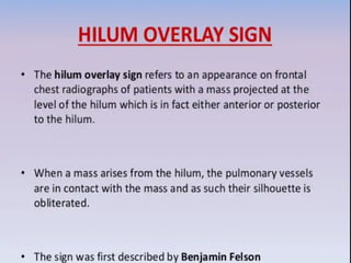 Hilom Sign some important chest xray signs in radiography.pptx