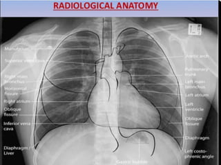some important chest xray signs in radiography.pptx