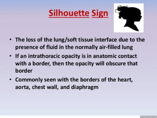 some important chest xray signs in radiography.pptx
