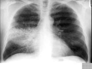some important chest xray signs in radiography.pptx