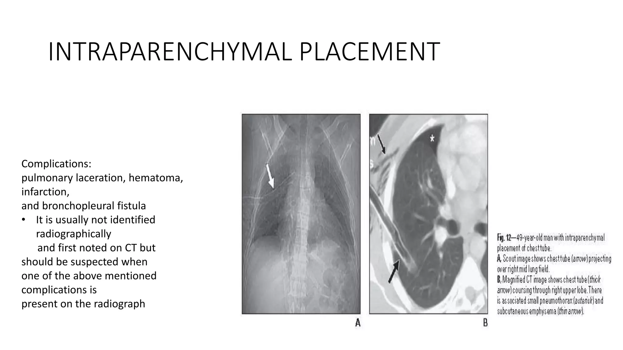 Pbc Radiographically Chest x rays swati | PPTX