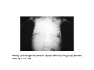 Marked cardiomegaly in newborn has few differential diagnoses, Ebstein’s
anomaly in this case
 