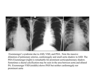 Eisenmenger’s syndrome due to ASD, VSD, and PDA . Note the massive
dilatation of pulmonary arteries, cardiomegaly and small aorta shadow in ASD. The
PDA Eisenmenger (right) is remarkable for prominent aorticopulmonary shadow.
Sometimes a ductal calcification may be seen in the area between aorta and dilated
PA. Eisenmenger VSD (middle) shows PAH but neither cardiomegaly nor
prominent aorta
 