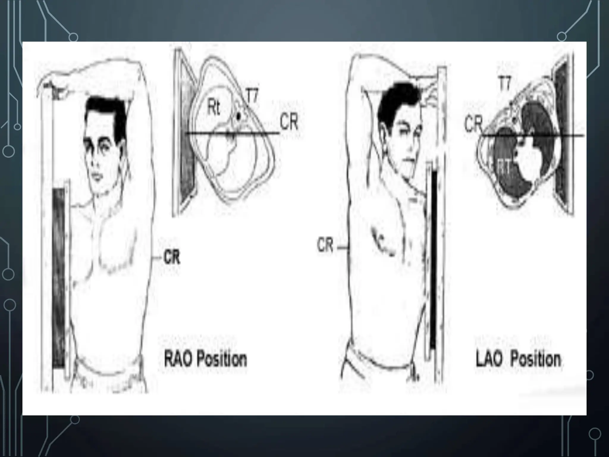 Basic Chest X ray Views - AP, PA & Lateral etc . pptx | PPTX