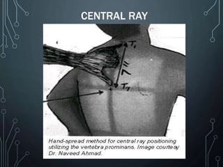 CENTRAL RAY
 