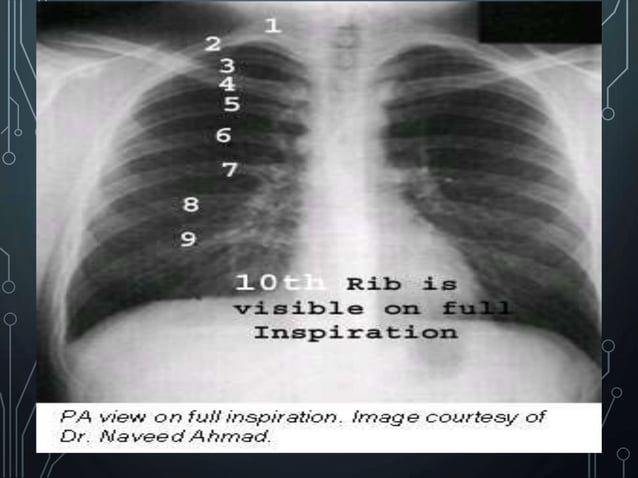 Basic Chest X ray Views - AP, PA & Lateral etc . pptx | PPTX