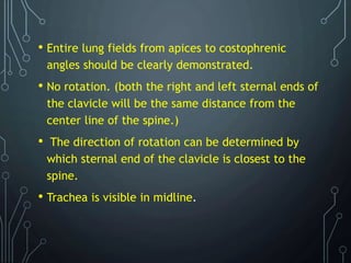 • Entire lung fields from apices to costophrenic
angles should be clearly demonstrated.
• No rotation. (both the right and left sternal ends of
the clavicle will be the same distance from the
center line of the spine.)
• The direction of rotation can be determined by
which sternal end of the clavicle is closest to the
spine.
• Trachea is visible in midline.
 