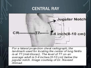 CENTRAL RAY
 