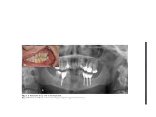 inferior alveolar nerve lateralization
