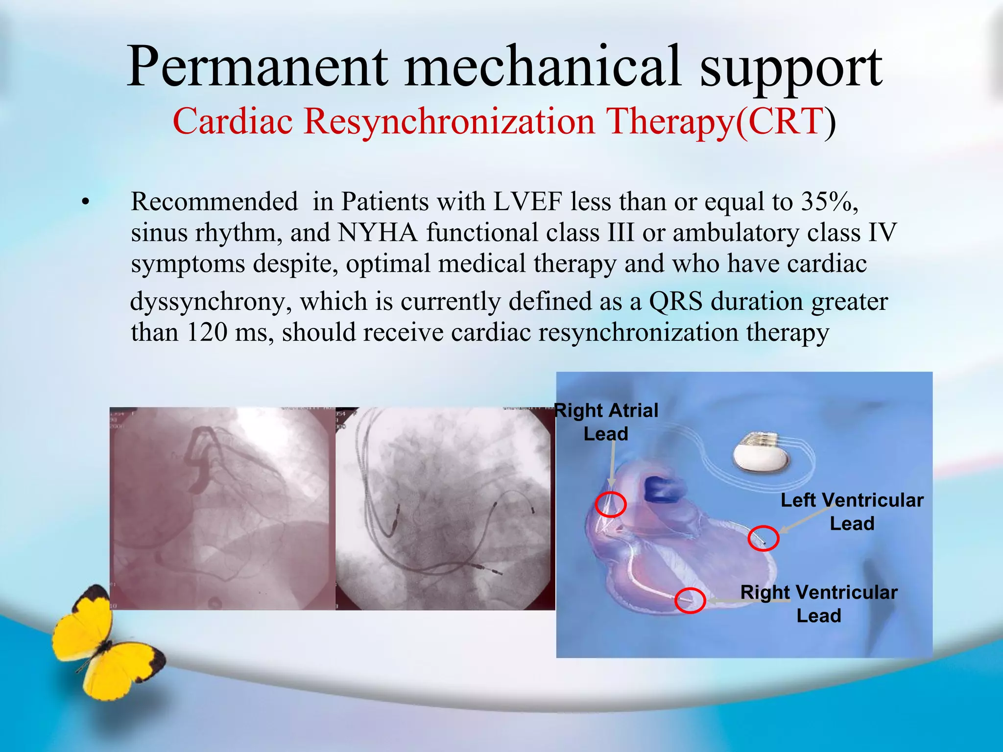 Permanent mechanical support Cardiac Resynchronization Therapy(CRT ) Recommended  in Patients with LVEF less than or equal to 35%, sinus rhythm, and NYHA functional class III or ambulatory class IV symptoms despite, optimal medical therapy and who have cardiac  dyssynchrony, which is currently defined as a QRS duration greater than 120 ms, should receive cardiac resynchronization therapy  Right Atrial Lead Right Ventricular Lead Left Ventricular Lead 