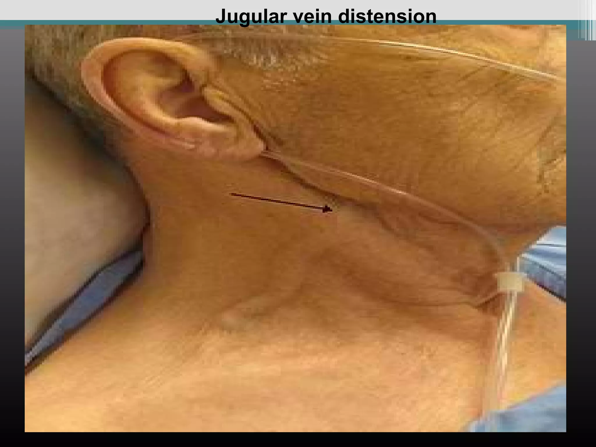 Jugular vein distension

 