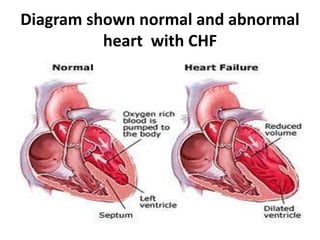 Diagram shown normal and abnormal
heart with CHF
 