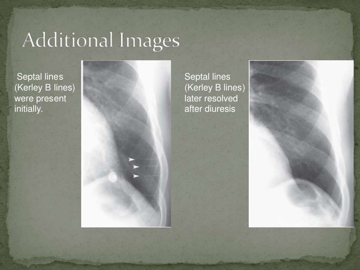 Congestive Heart Failure Fpnotebook Com