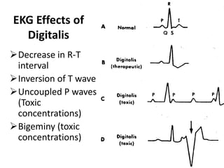 EKG Effects of
Digitalis
Decrease in R-T
interval
Inversion of T wave
Uncoupled P waves
(Toxic
concentrations)
Bigeminy (toxic
concentrations)
 