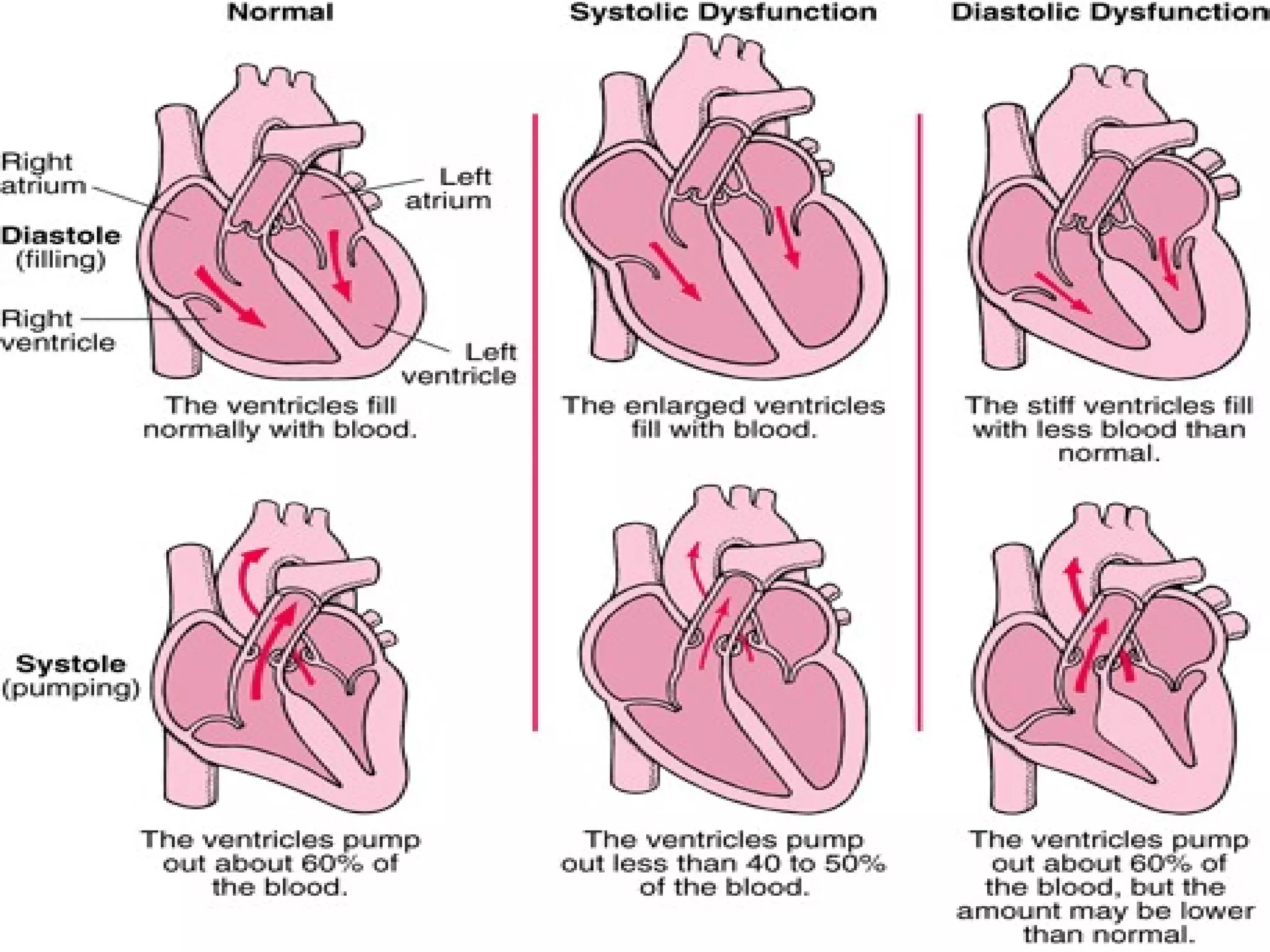 Pathophysiology Of Congestive Heart Failure Pdf Congestive heart failure pathophysiology | PPT