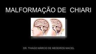MALFORMAÇÃO DE CHIARI
DR. THIAGO MÁRCIO DE MEDEIROS MACIEL
 