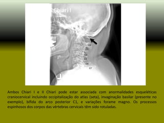 Ambos Chiari I e II Chiari pode estar associada com anormalidades esqueléticas
craniocervical incluindo occipitalização do atlas (seta), invaginação basilar (presente no
exemplo), bífida do arco posterior C1, e variações forame magno. Os processos
espinhosos dos corpos das vértebras cervicais têm sido rotuladas.
 