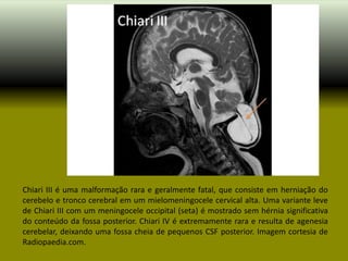 Chiari III é uma malformação rara e geralmente fatal, que consiste em herniação do
cerebelo e tronco cerebral em um mielomeningocele cervical alta. Uma variante leve
de Chiari III com um meningocele occipital (seta) é mostrado sem hérnia significativa
do conteúdo da fossa posterior. Chiari IV é extremamente rara e resulta de agenesia
cerebelar, deixando uma fossa cheia de pequenos CSF posterior. Imagem cortesia de
Radiopaedia.com.
 