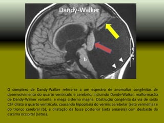 O complexo de Dandy-Walker refere-se a um espectro de anomalias congênitas de
desenvolvimento do quarto ventrículo e cerebelo, incluindo Dandy-Walker, malformação
de Dandy-Walker variante, e mega cisterna magna. Obstrução congênita da via de saída
CSF dilata o quarto ventrículo, causando hipoplasia do vermis cerebelar (seta vermelha) e
do tronco cerebral (b), e dilatação da fossa posterior (seta amarela) com desbaste da
escama occipital (setas).
 