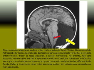 Cistos aracnóide gigantesca podem imitar malformação de Dandy-Walker. Cistos aracnóide
Retrocerebellar (seta amarela) pode deslocar o quarto ventrículo (seta vermelha) e cerebelo
anteriormente, dilatar os fossa posterior, e causar hidrocefalia. No entanto, não será
associado malformações do SNC e tipicamente o cisto vai deslocar numerosos minúsculos
vasos que normalmente estar presente no quarto ventrículo. A distinção da malformação de
Dandy-Walker é importante como cistos aracnóide podem ser tratados com ressecção ou
marsupialização.
 