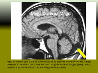 Mega cisterna magna é o mais suave entidade no espectro de Dandy-Walker. A fossa
posterior é ampliada por causa de uma alargada cisterna magna (seta), mas o
cerebelo e quarto ventrículo são morfologicamente normal.
 