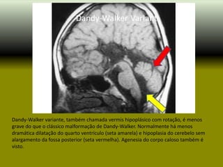 Dandy-Walker variante, também chamada vermis hipoplásico com rotação, é menos
grave do que o clássico malformação de Dandy-Walker. Normalmente há menos
dramática dilatação do quarto ventrículo (seta amarela) e hipoplasia do cerebelo sem
alargamento da fossa posterior (seta vermelha). Agenesia do corpo caloso também é
visto.
 