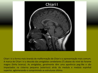 Chiari I é a forma mais branda de malformação de Chiari e a apresentação mais comum.
A marca de Chiari I é a descida das amígdalas cerebelares (T) abaixo do nível do forame
magno (linha branca). As amígdalas, geralmente têm uma aparência peg-like e são
impactados na cisterna pequena (asterisco) atrás da medula e medula espinhal
superior, aglomerando e comprimindo as estruturas último.
 